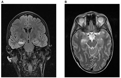 Olfactory dysfunction after autoimmune encephalitis depending on the antibody type and limbic MRI pathologies